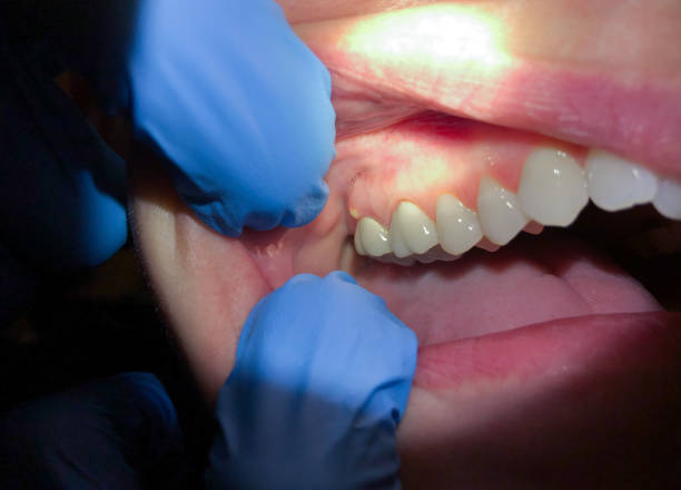 Best Emergency Dentist for Lost Fillings or Crowns in Central Gardens, TX